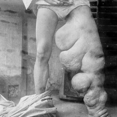 ELEPHANTIASIS – The Swelling Infestation