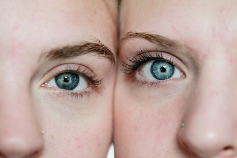 5 Interesting Facts About Conjoined Twins