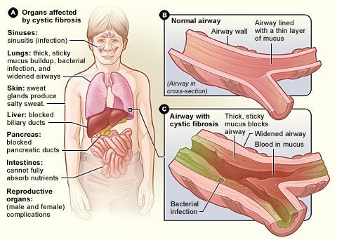 17 Enlightening Cystic Fibrosis Facts
