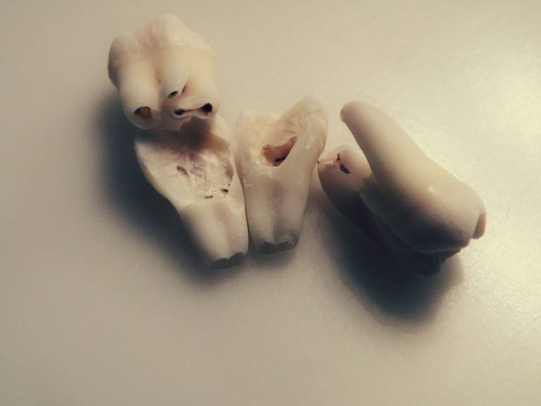 Why Do We Have Wisdom Teeth?