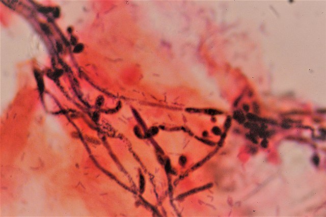 13 Little-Known Yeast Infections Facts