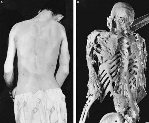 Fibrodysplasia Ossificans Progressiva