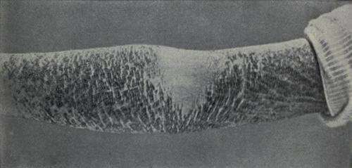Ichthyosis ALLIGATOR-SKINNED MARVELS